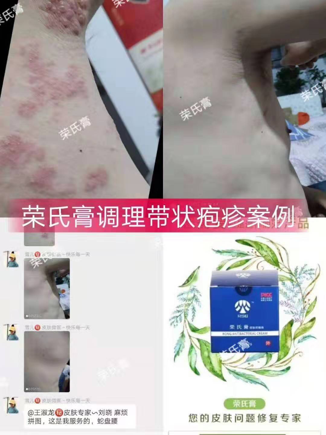 1593783468597544.jpg 带状疱疹.jpg